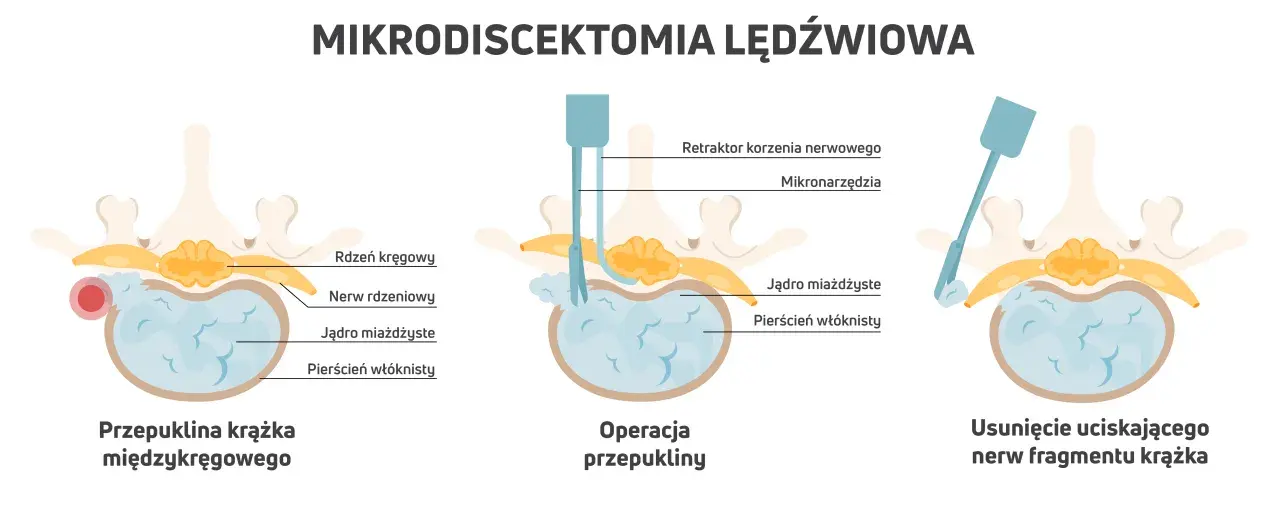 Ilustracja pokazuje mikrodiscektomię lędźwiową: przepuklinę, operację i usunięcie fragmentu krążka. Pamiętaj, czego nie wolno robić po operacji kręgosłupa lędźwiowego.