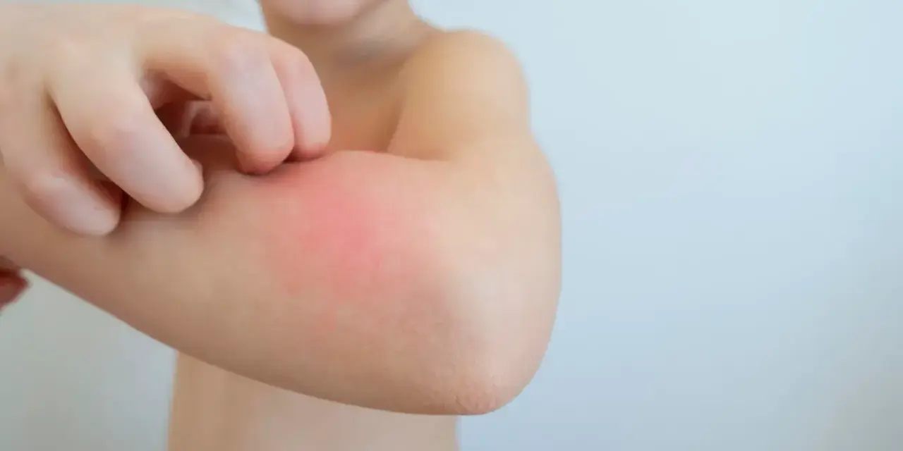 Kind kratzt sich am roten, geschwollenen Arm. Tipps, wie man Schnakenstiche behandeln kann, sind hier wichtig.