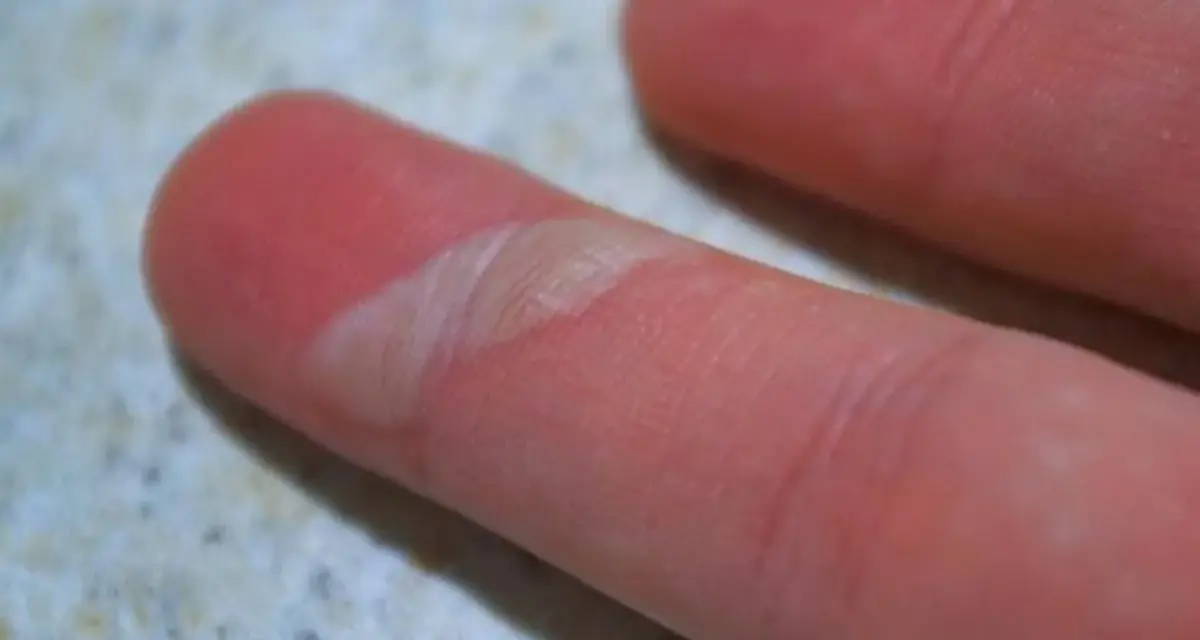 Nahaufnahme eines Fingers mit einer offenen Blase, die behandelt werden muss. Die Haut ist gerötet und die Blase ist aufgeplatzt.