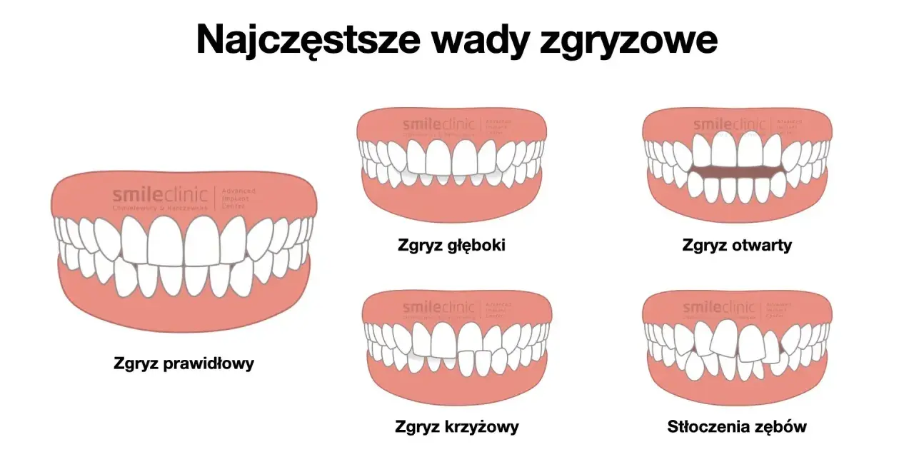Ilustracja pokazuje różne rodzaje wad zgryzu: prawidłowy, głęboki, otwarty, krzyżowy i stłoczenia. Prawidłowa okluzja jest kluczowa dla zdrowia jamy ustnej.