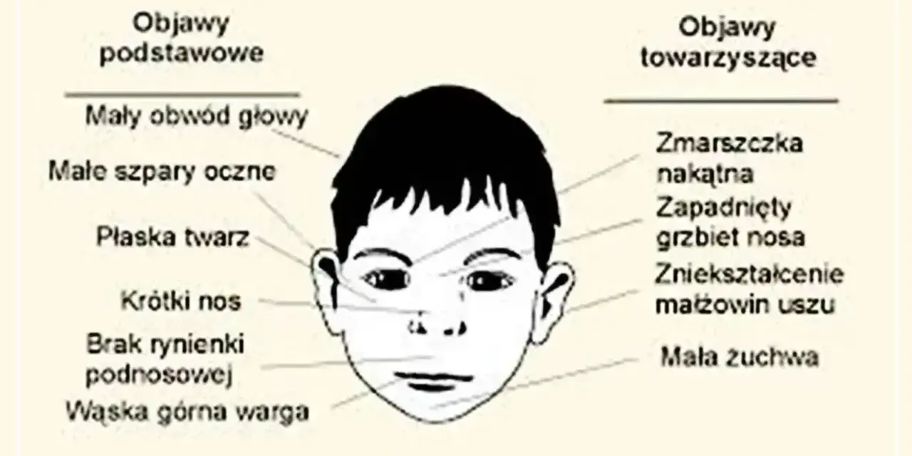 Ilustracja przedstawia cechy twarzy dziecka z FASD: mały obwód głowy, płaska twarz, krótki nos, wąska górna warga, zmarszczka nakątna, zapadnięty grzbiet nosa.