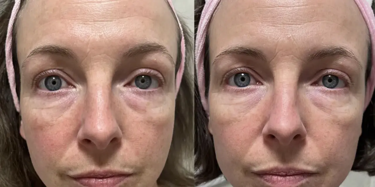 Confronto viso: pelle con niacinamide prima e dopo. Miglioramento di rossori e texture.
