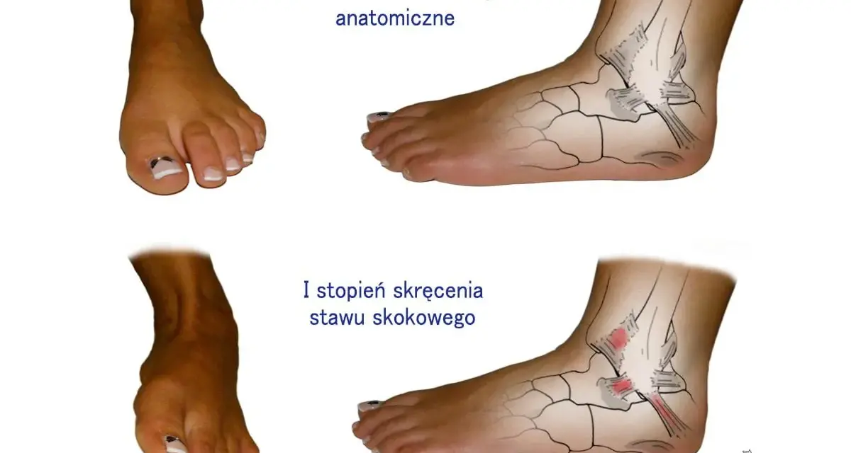Porównanie prawidłowej anatomii stawu skokowego z I stopniem skręcenia. Widoczne uszkodzenia więzadeł.