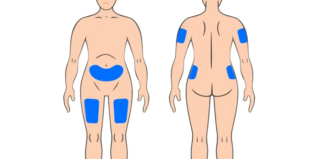 Körperstellen für Injektionen: Bauch, Oberschenkel, Oberarme und Gesäß. So kann man weit spritzen.