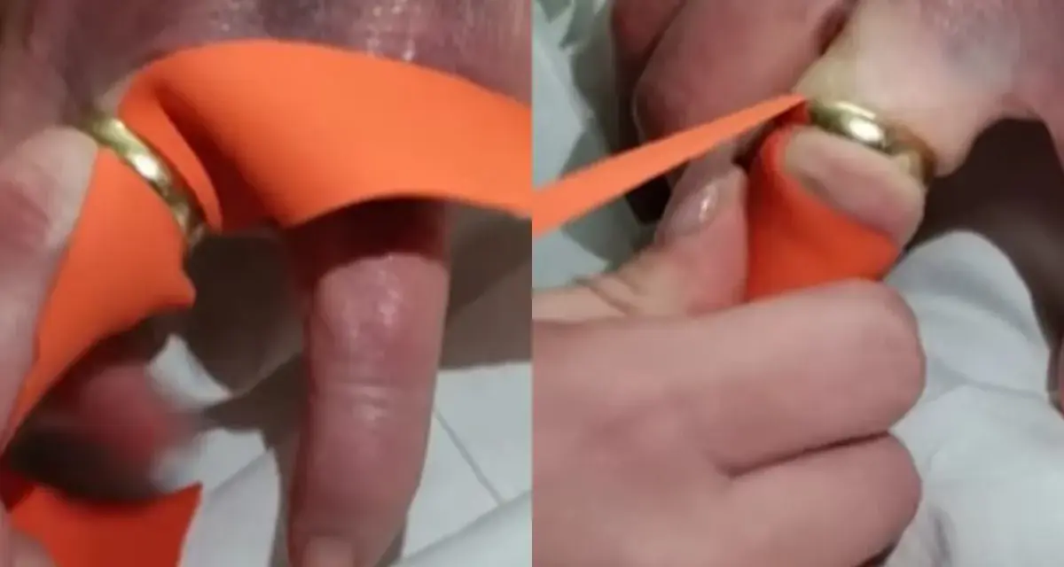 Pomoc w zdjęciu pierścionka z bardzo spuchniętego palca za pomocą pomarańczowej wstążki. Technika ta pomaga zmniejszyć obrzęk.