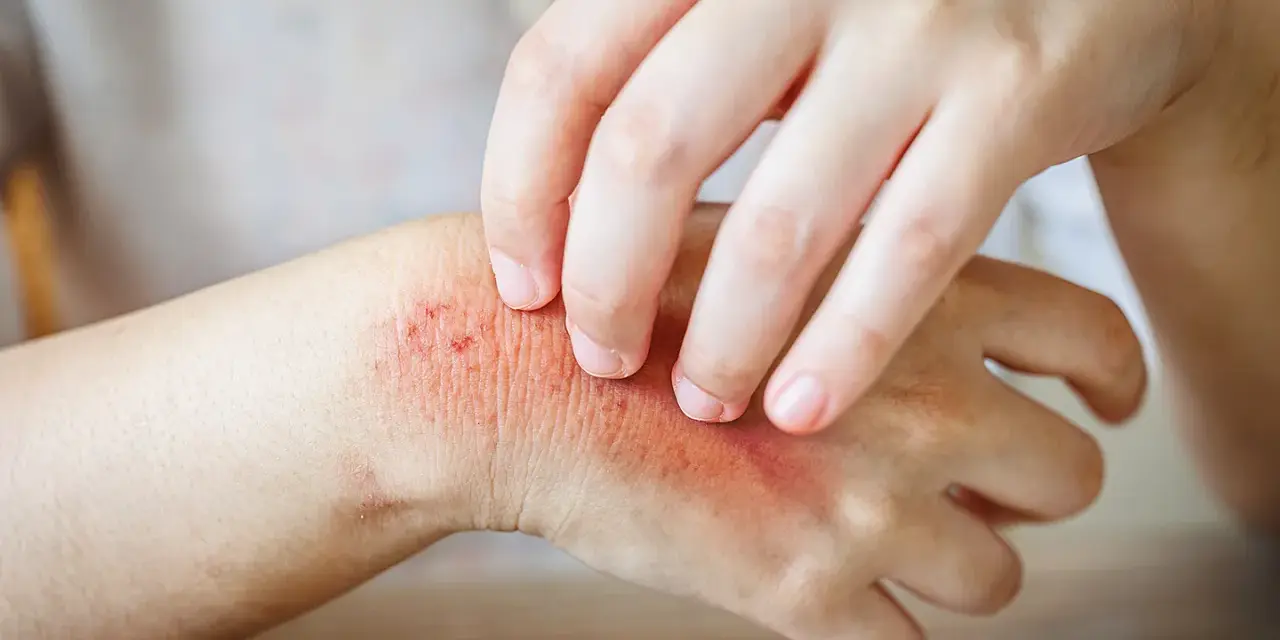 Juckende Haut: Ein Ekzem an der Hand, das durch Kratzen verschlimmert wird.