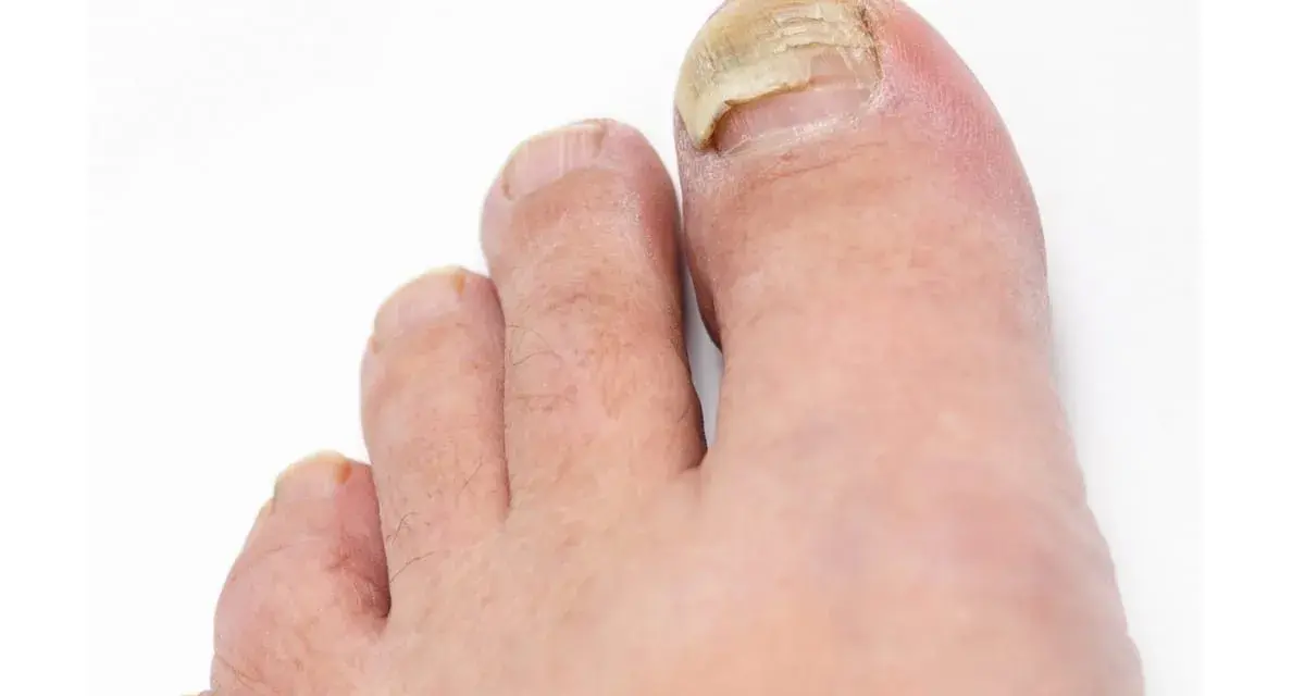 Gros plan sur un pied, montrant un ongle qui se décolle, jauni et épaissi, signe d'une mycose.