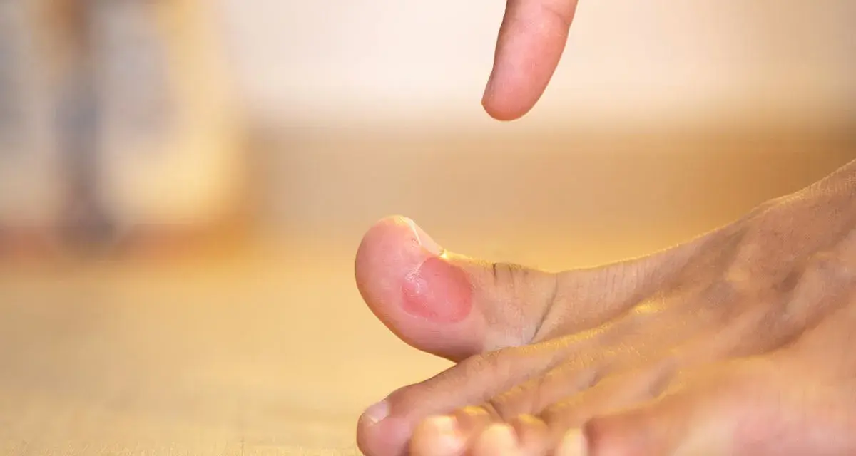 Ein Finger zeigt auf eine schmerzende blutblase am zeh.