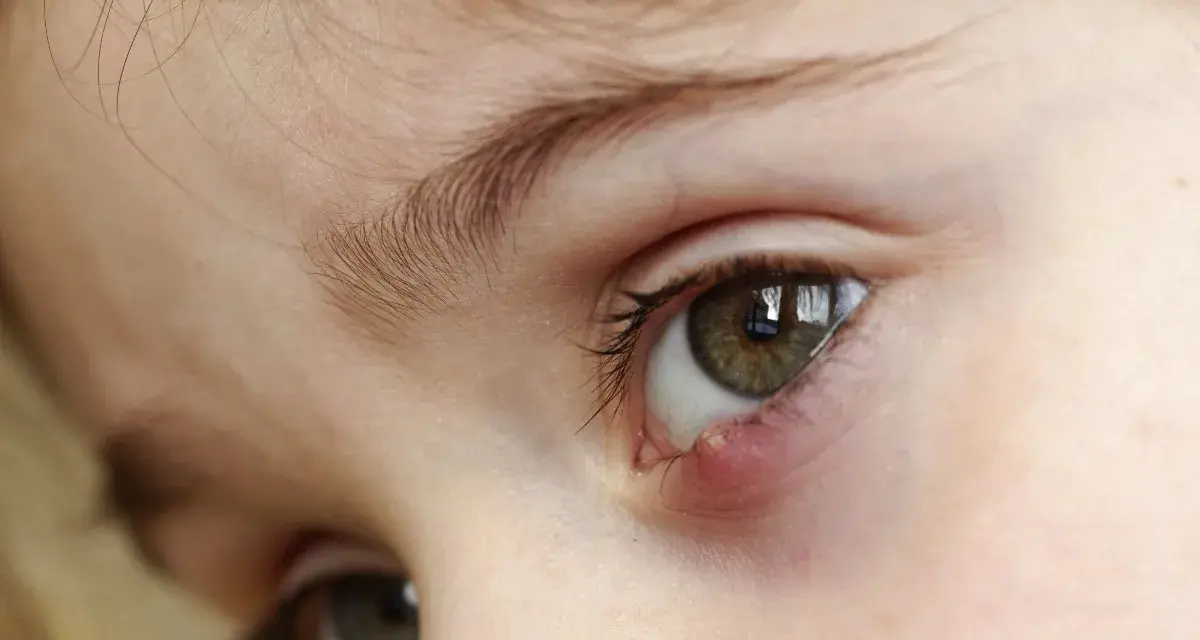 Occhio di bambino con un orzaiolo, segno di stress o stanchezza.