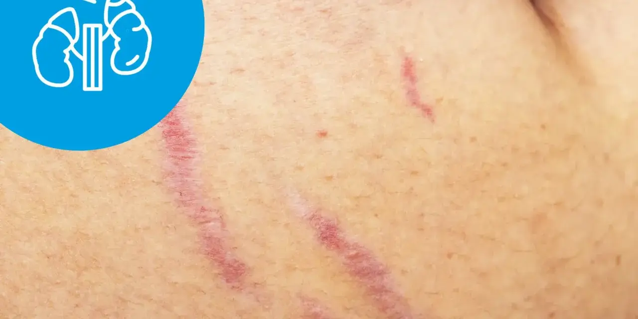 Rozstępy na skórze, które mogą być objawem choroby Cushinga. W lewym górnym rogu ikona nerek.