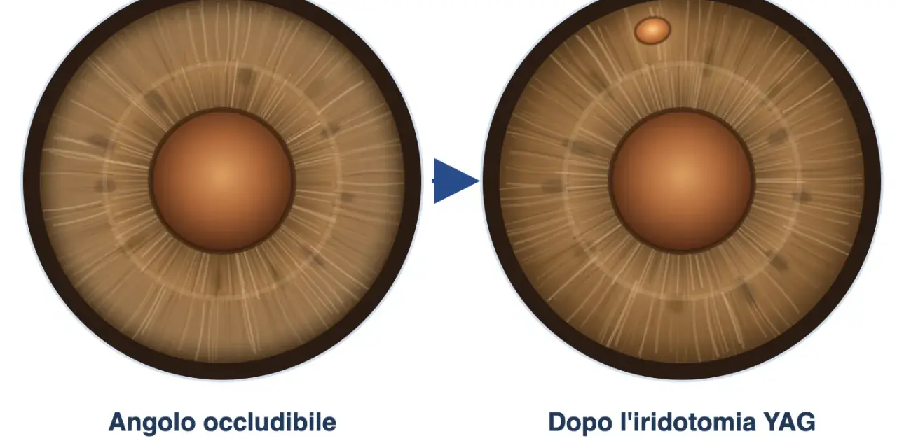 Iridotomia YAG: prima occlusione dell'angolo, dopo apertura per riaprire il deflusso. Valutare i rischi.