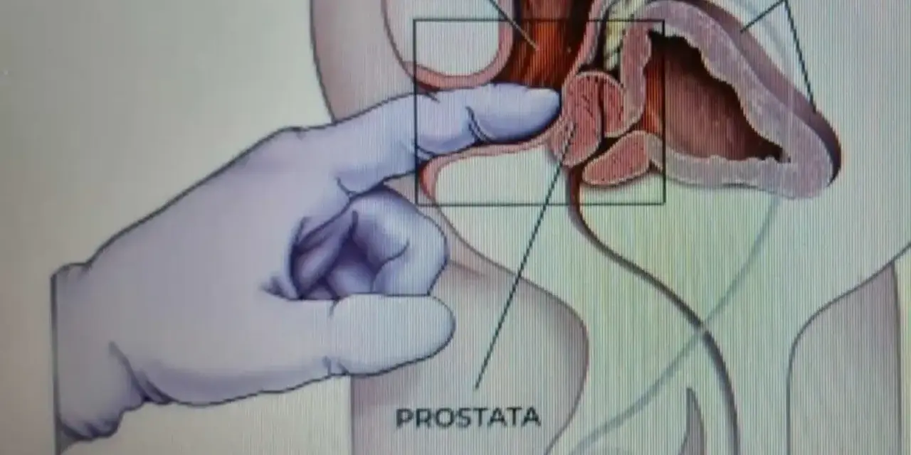 Ilustracja medyczna przedstawiająca palec w rękawiczce wykonujący masaż prostaty przez odbytnicę.