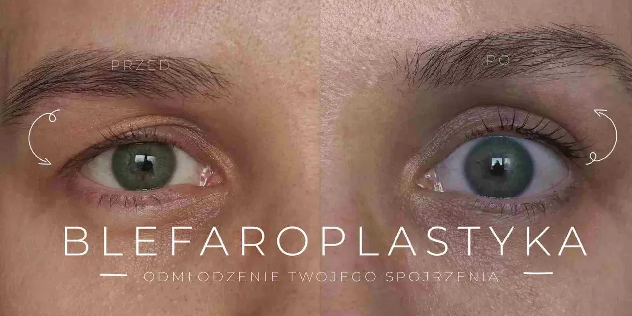 Przed i po zabiegu blefaroplastyki powiek. Odmłodzone spojrzenie, usunięcie opadających powiek.