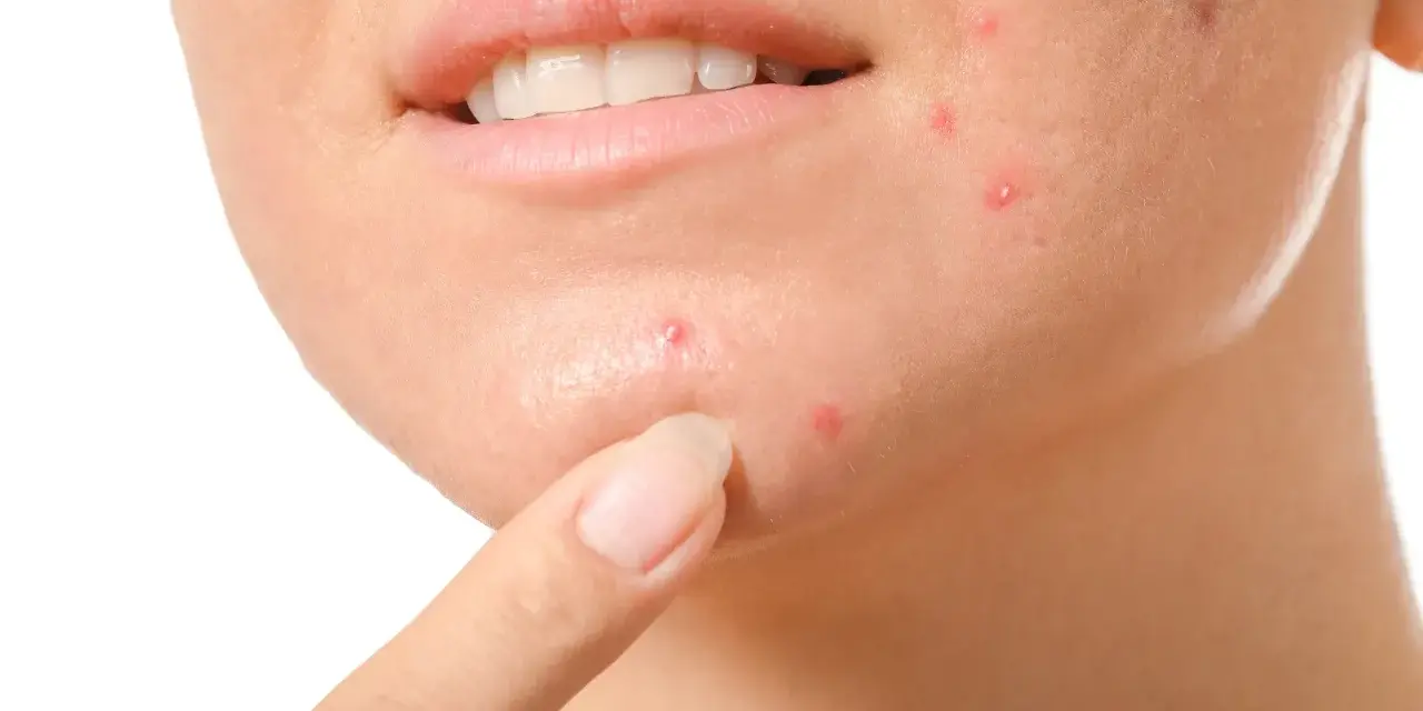 Primo piano del viso di una persona con evidenti segni di acne cistica sul mento e sulla guancia, con un dito che indica una lesione.