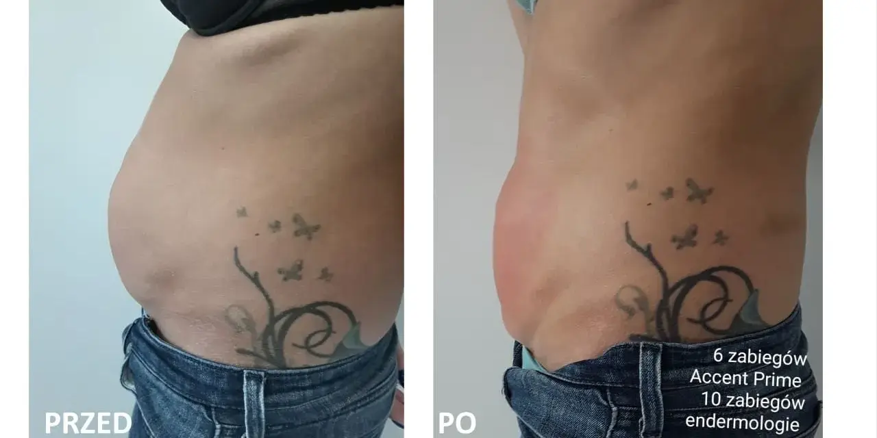 Przed i po zabiegu Accent Prime. Widoczna redukcja tkanki tłuszczowej brzucha, co pokazuje skuteczność liposukcji kawitacyjnej.