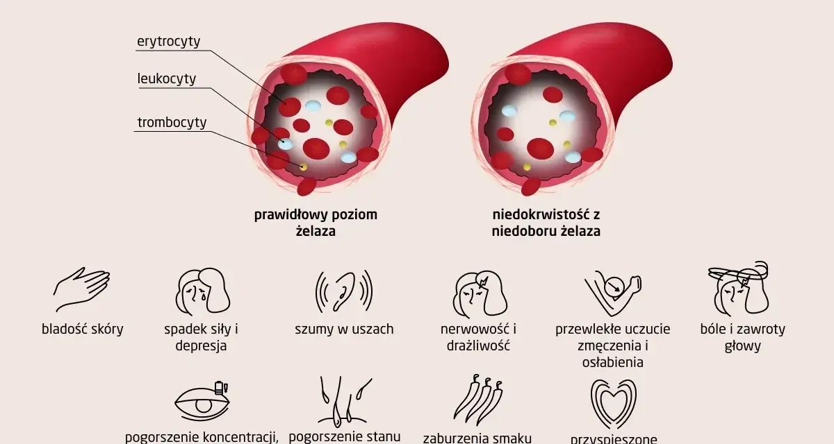 Prawidłowy poziom żelaza w naczyniu krwionośnym vs. niedobór żelaza. Objawy anemii: bladość, zmęczenie, szumy w uszach, bóle głowy.