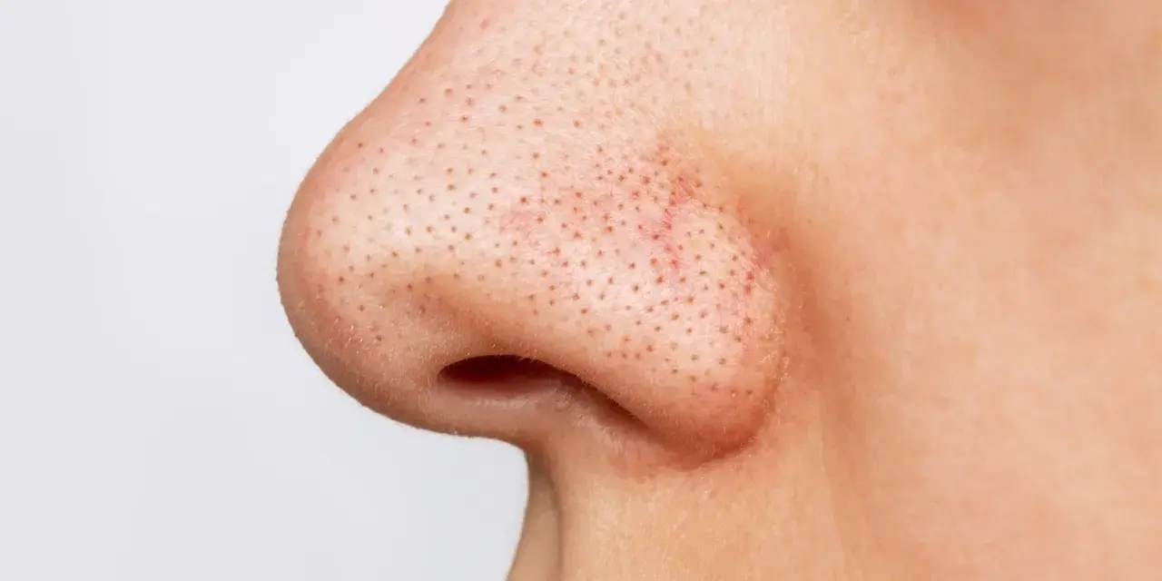 Gros plan sur un nez avec de nombreux points noirs visibles.