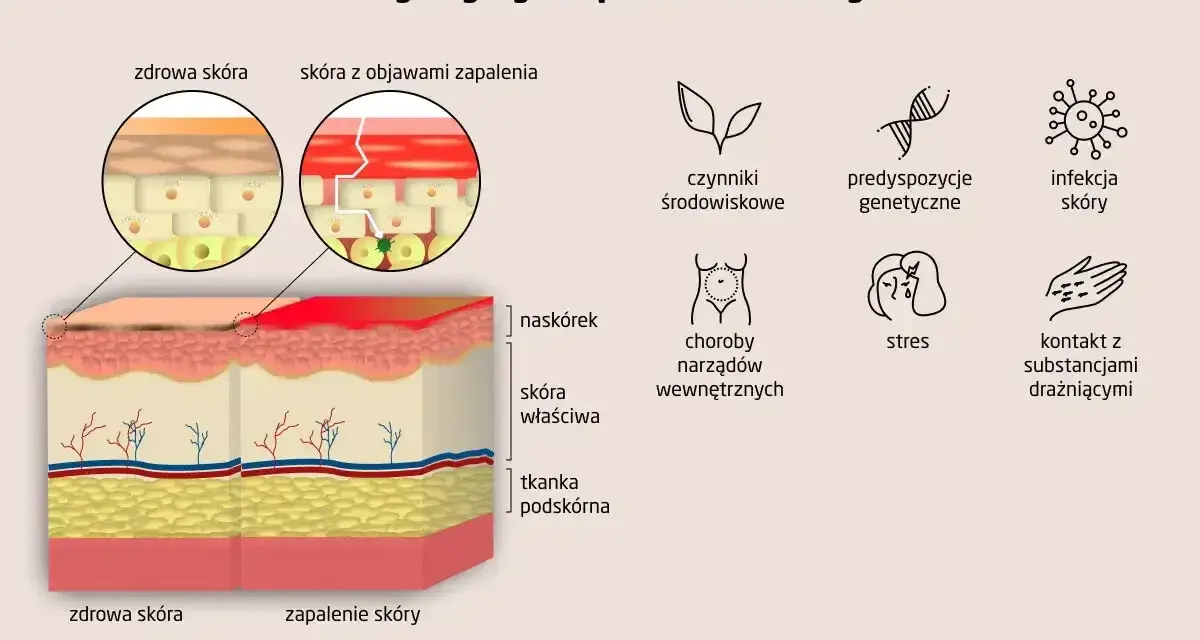 Ilustracja porównująca zdrową skórę i skórę z zapaleniem, z ikonami przedstawiającymi przyczyny AZS.