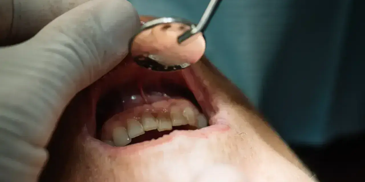Usta pacjenta z widocznym zaczerwienieniem i obrzękiem dziąseł, wskazującym na nieleczony ropień zęba. Dentysta bada jamę ustną lusterkiem.