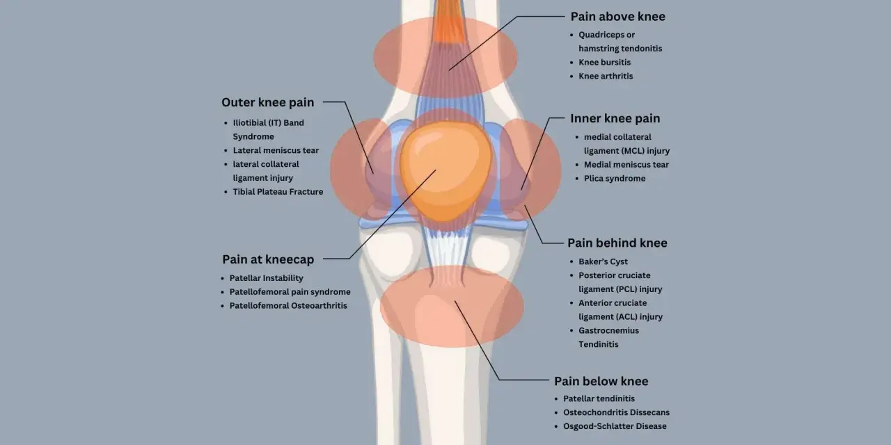 Diagram showing knee pain locations and causes. Excessive spinning can be bad for your knees, leading to issues like IT band syndrome or meniscus tears.