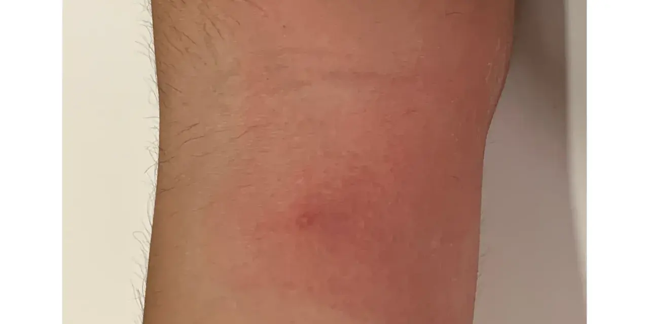 Piel enrojecida con una pequeña protuberancia, indicativa de picaduras chinches de cama como eliminarlas.