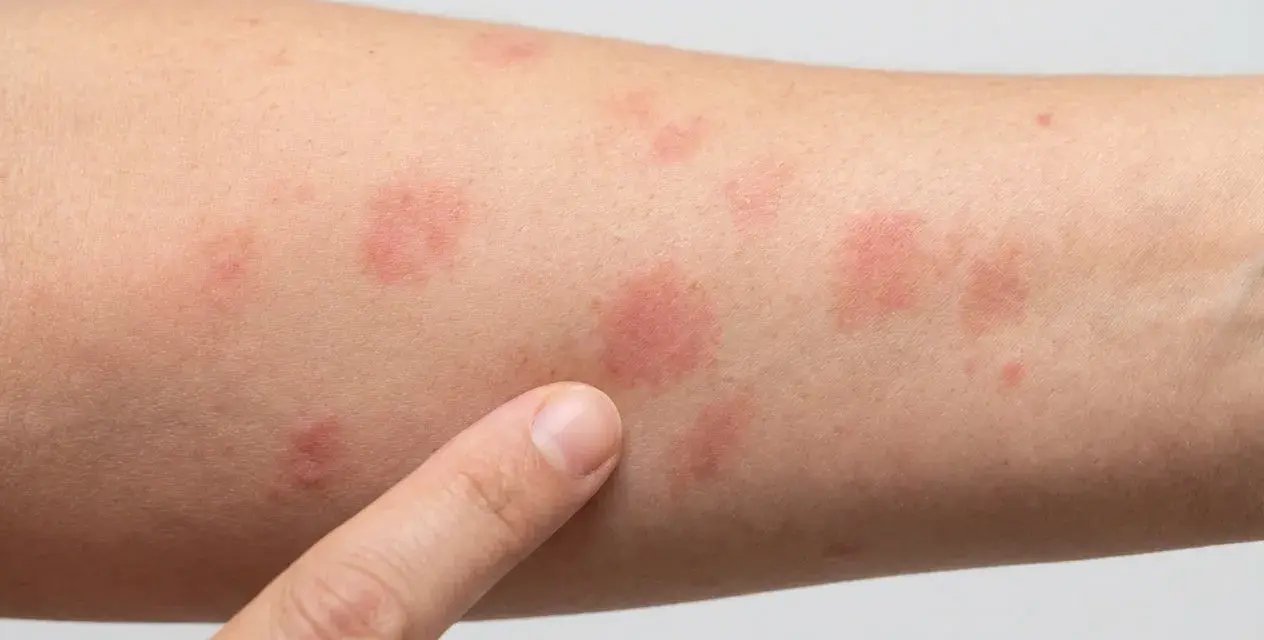 Nahaufnahme eines Arms mit mehreren roten Stellen auf der Haut, die auf einen Ausschlag oder eine allergische Reaktion hindeuten.