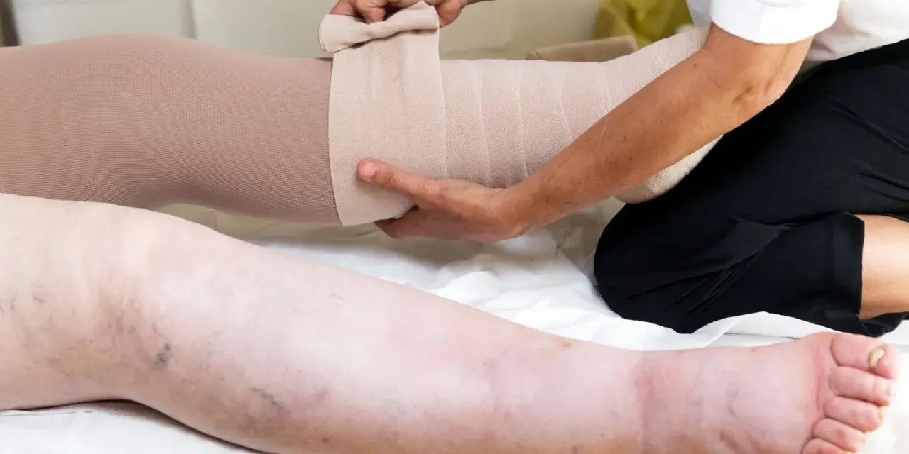 Beine werden bandagiert, um die Lymphdrainage selbst machen zu können.