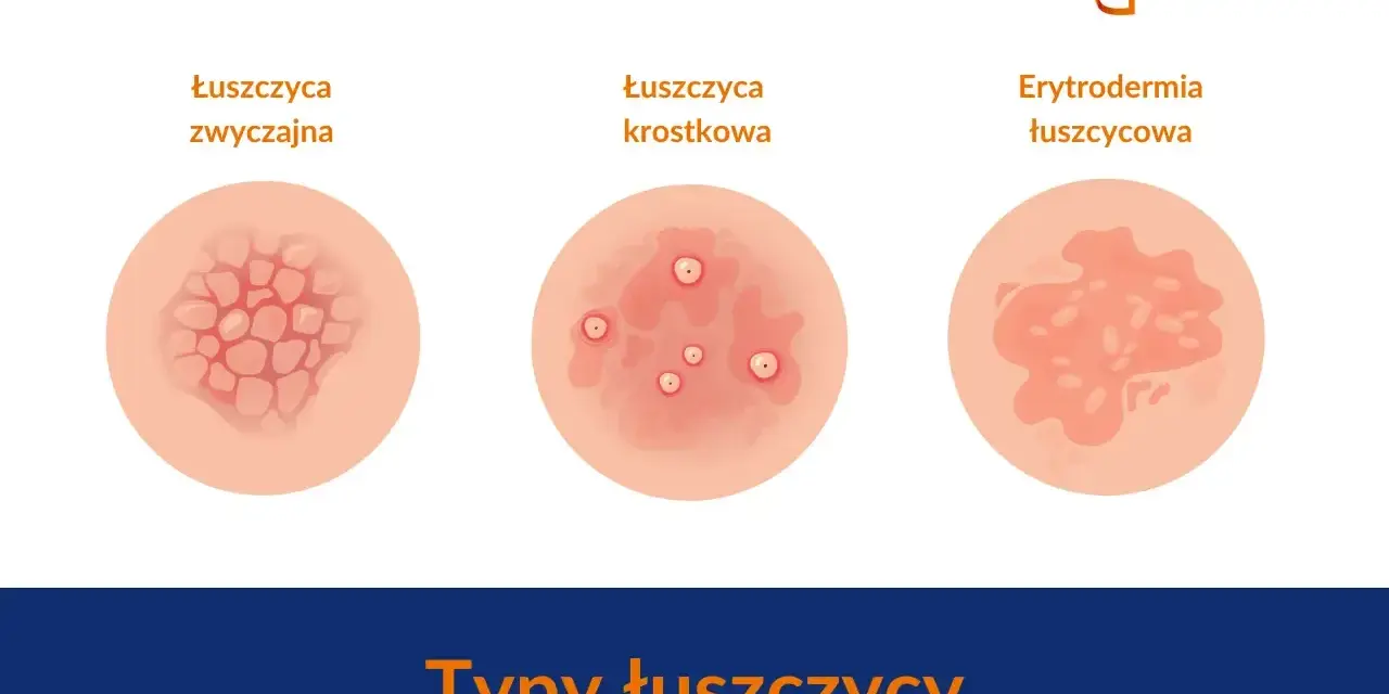 Ilustracje pokazują różne typy łuszczycy: zwyczajną, krostkową i erytrodermię łuszczycową. Ważne, by znać objawy łuszczycy u dzieci.