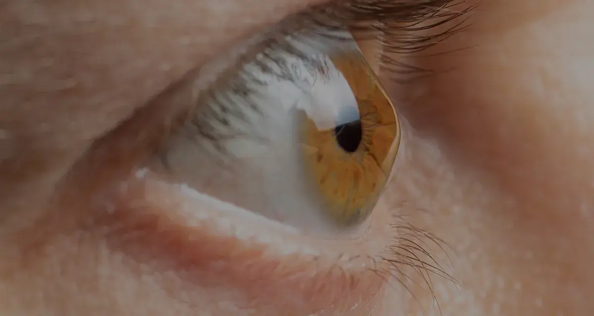 Occhio con iride ambrata e pupilla nera. La cornea deformata riflette la luce, creando un effetto visivo particolare.