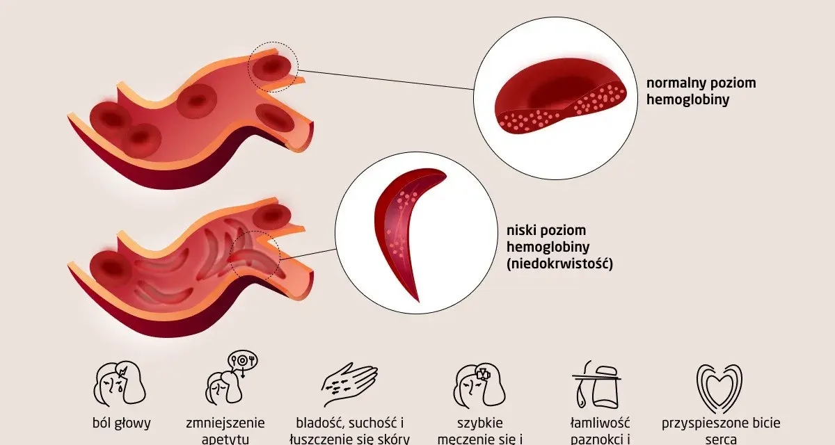 Ilustracja pokazuje objawy niskiego poziomu hemoglobiny, takie jak ból głowy, bladość i szybkie męczenie się. Dowiedz się, jak podnieść hemoglobinę.