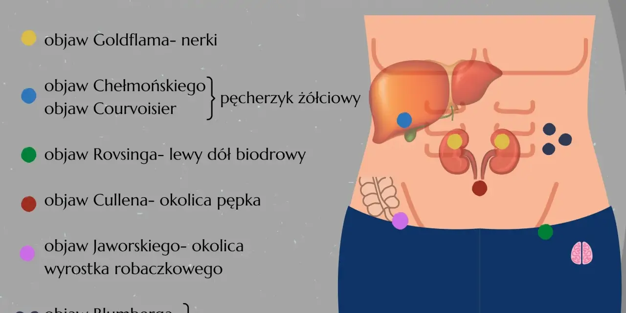 Objaw Rovsinga zaznaczony zieloną kropką w lewym dole biodrowym, ilustrujący objawy z jamy brzusznej.