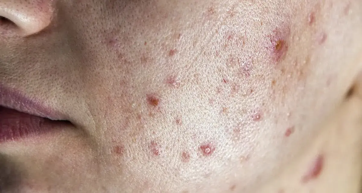 Primo piano della pelle con acne, inclusi diversi brufoli cistici e rossori.