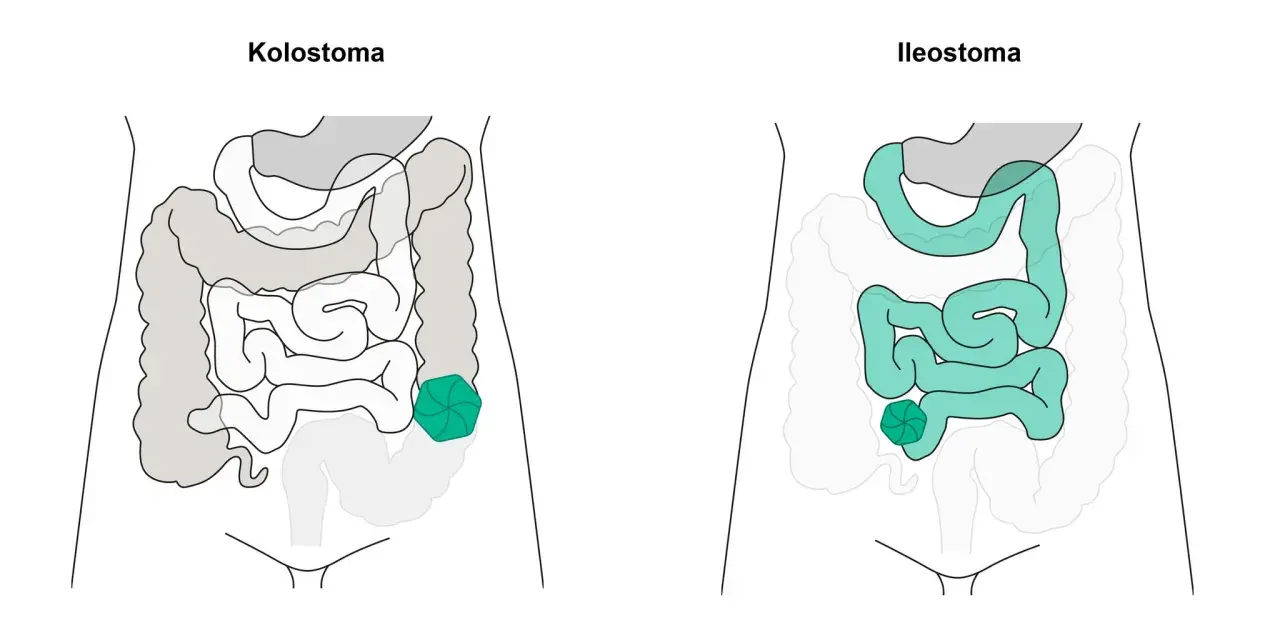Vergleich von Kolostoma und Ileostoma: zwei stoma arten, die den Darm betreffen.