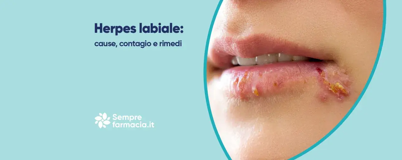 Herpes labiale: cause, contagio e rimedi. Scopri come curare l'herpes labiale e alleviare i sintomi.