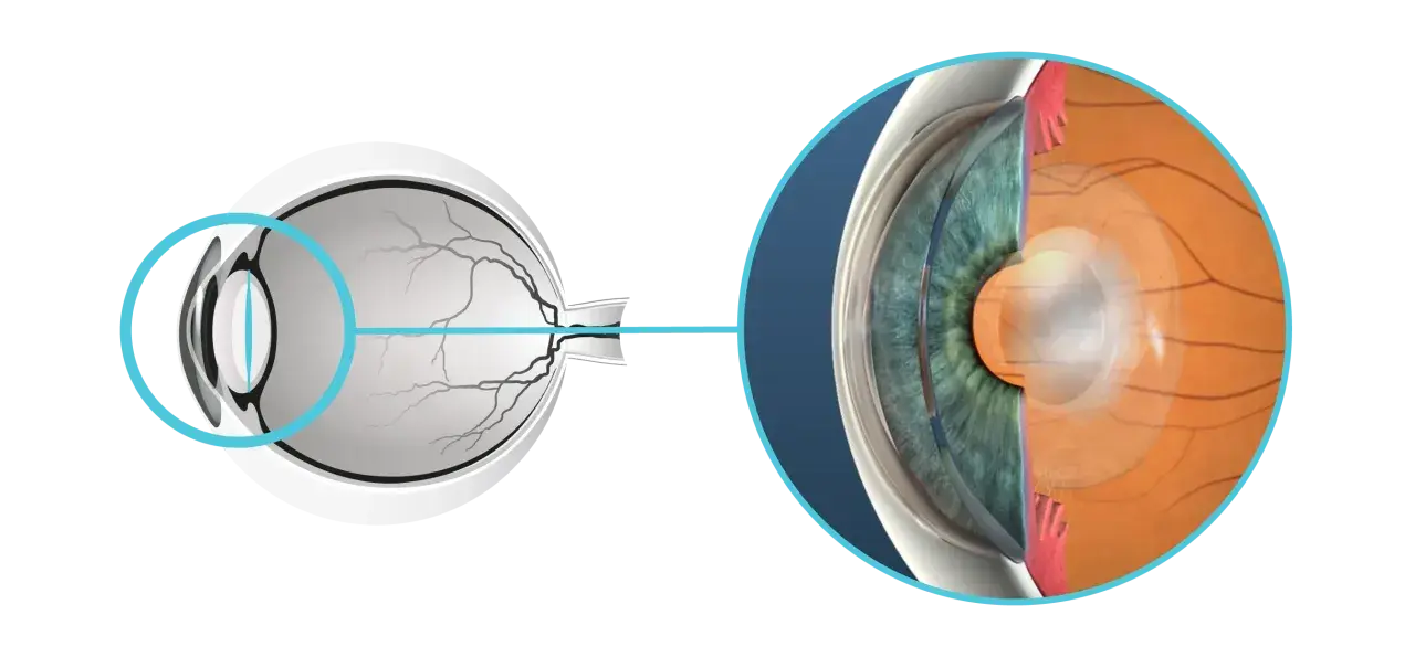 Sezione dell'occhio che mostra la lente e la retina. Si notano aloni dopo capsulotomia, un effetto visivo comune.