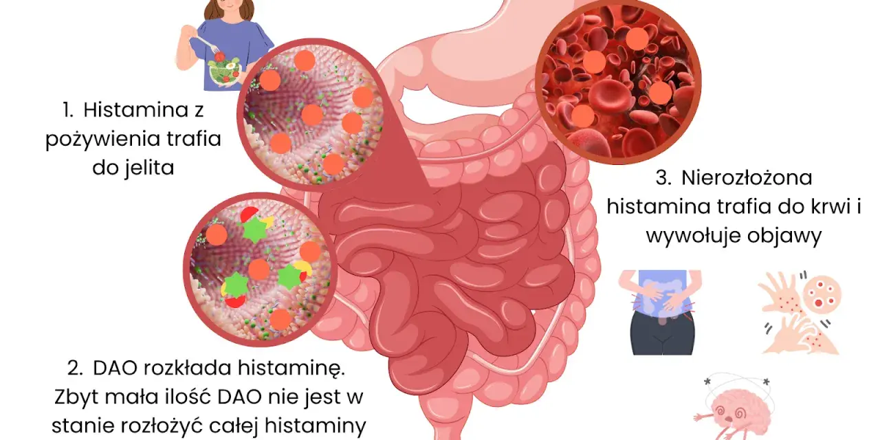 Ilustracja pokazuje, jak histamina z pożywienia trafia do jelita, jest rozkładana przez DAO, a jej nadmiar wywołuje objawy. Tabela produktów bez histaminy może pomóc w unikaniu problemów.