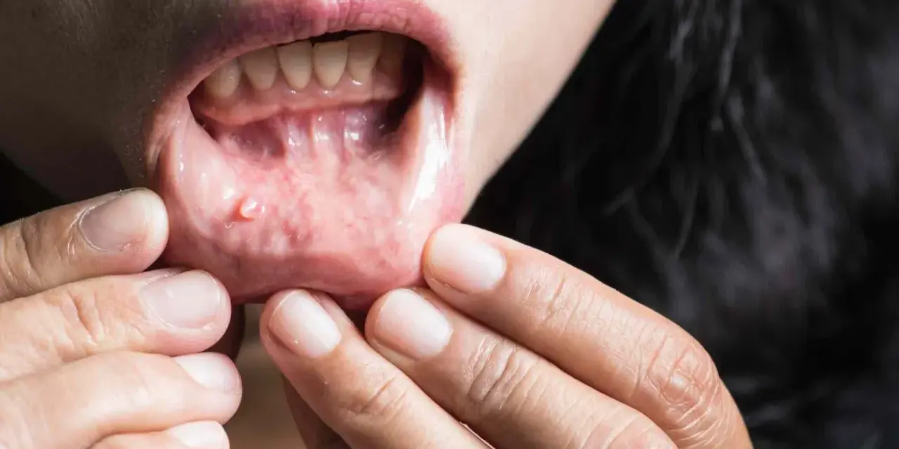 Una persona se revisa la boca, mostrando unos pequeños granos en los labios internos.