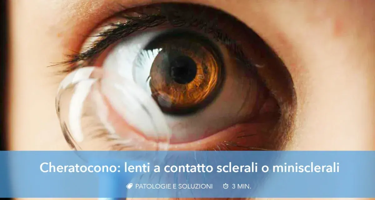 Occhio con cheratocono e lente a contatto applicata. Soluzioni per la visione con cheratocono.
