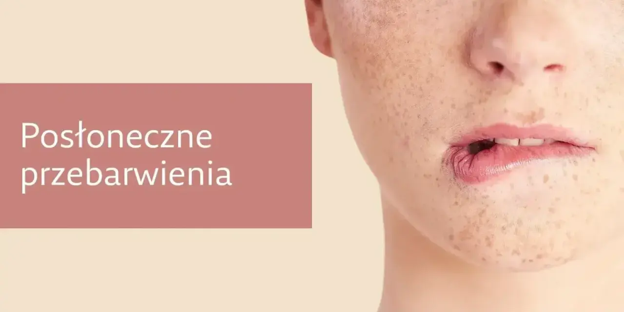 Jak poprawić koloryt cery? Widok zbliżenia na twarz z widocznymi przebarwieniami i piegami.