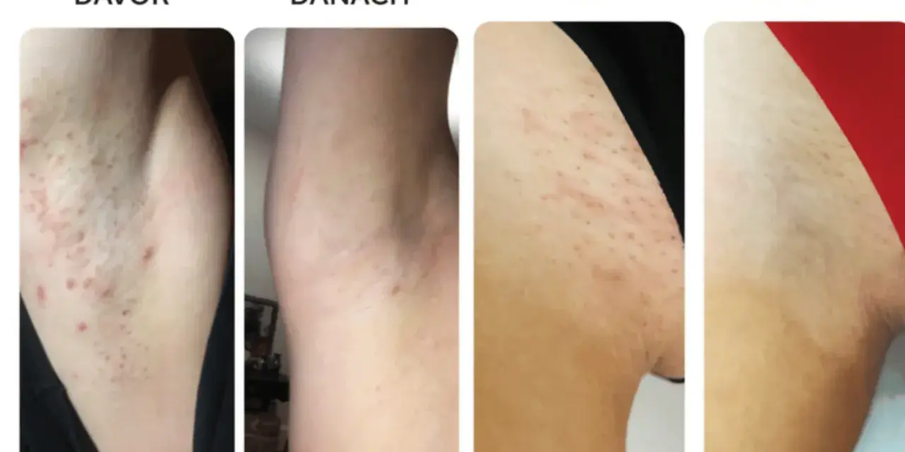 Vorher/Nachher-Bilder zeigen Achseln mit Pickeln nach dem Rasieren. Nach der Anwendung ist die Haut glatter, was zeigt, wie man rasieren ohne Pickel kann.
