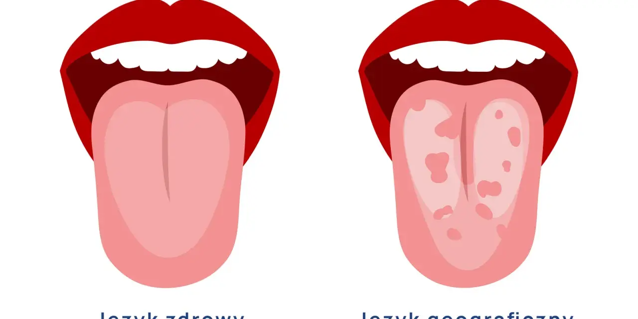 Dwa języki: zdrowy, gładki i geograficzny z plamkami, jakby żaba na języku zostawiła ślady.