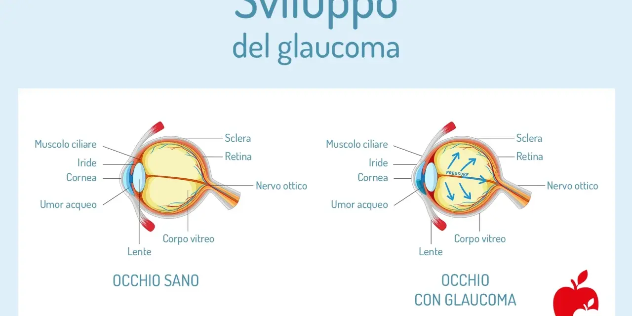 Confronto tra occhio sano e occhio con glaucoma, illustrando l'aumento di pressione. Il termine "abbigliamento significato" non si applica qui.