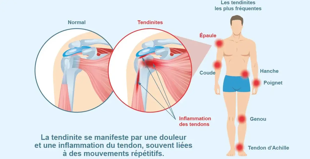 Illustration montrant une tendinite à l'épaule, une inflammation des tendons. L'ibuprofène peut aider à soulager ces douleurs.
