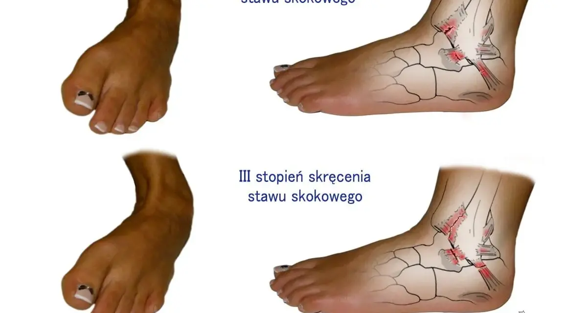 Ilustracje pokazują, jak wygląda złamana kostka: stopień II i III skręcenia stawu skokowego z uszkodzonymi więzadłami.