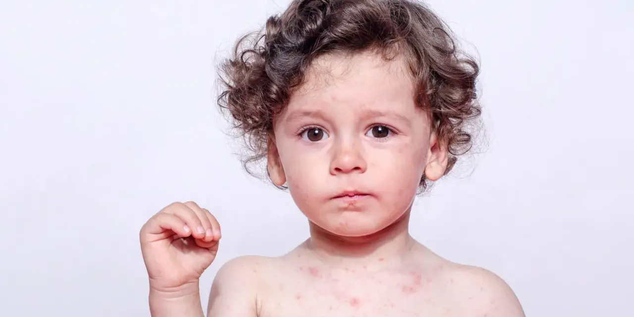 Szkarlatyna: Powrót do przedszkola? 24h po antybiotyku i decyzja lekarza