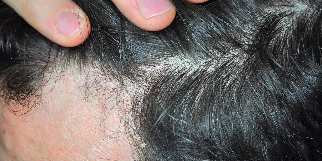 Dedos separando cabello oscuro con caspa blanca. ¿Cómo aliviar el picor de cabeza por estrés?