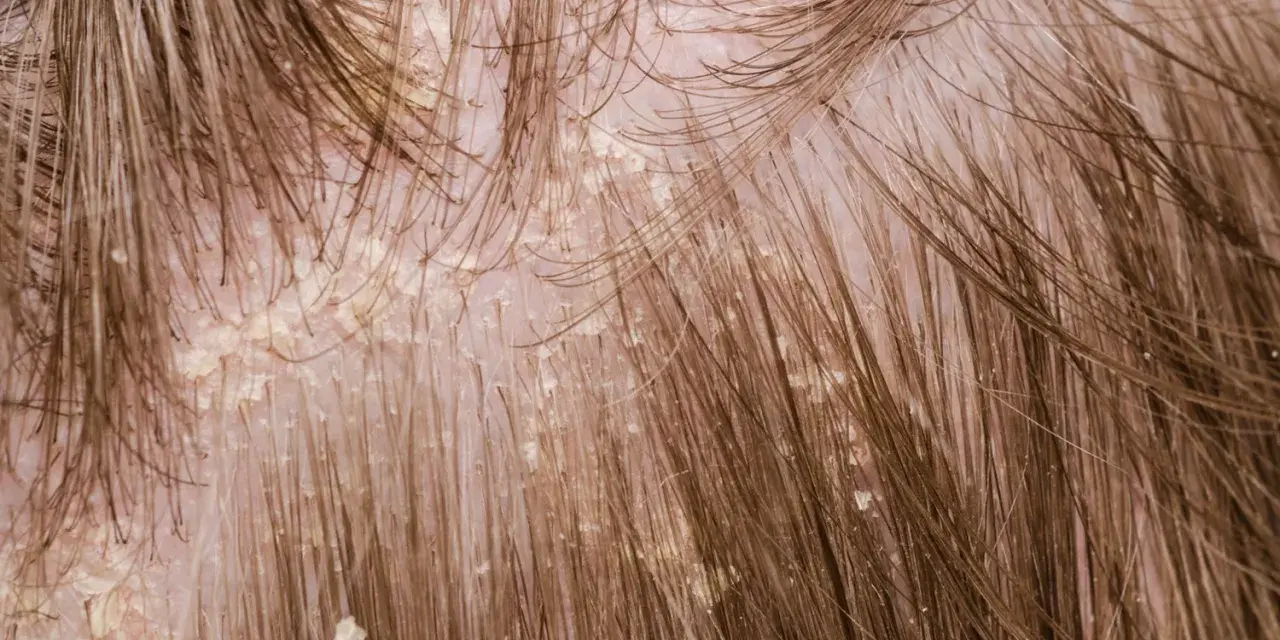 Nahaufnahme der Kopfhaut mit sichtbaren gelblichen Krusten und Schuppen, die sich zwischen den braunen Haaren abzeichnen.