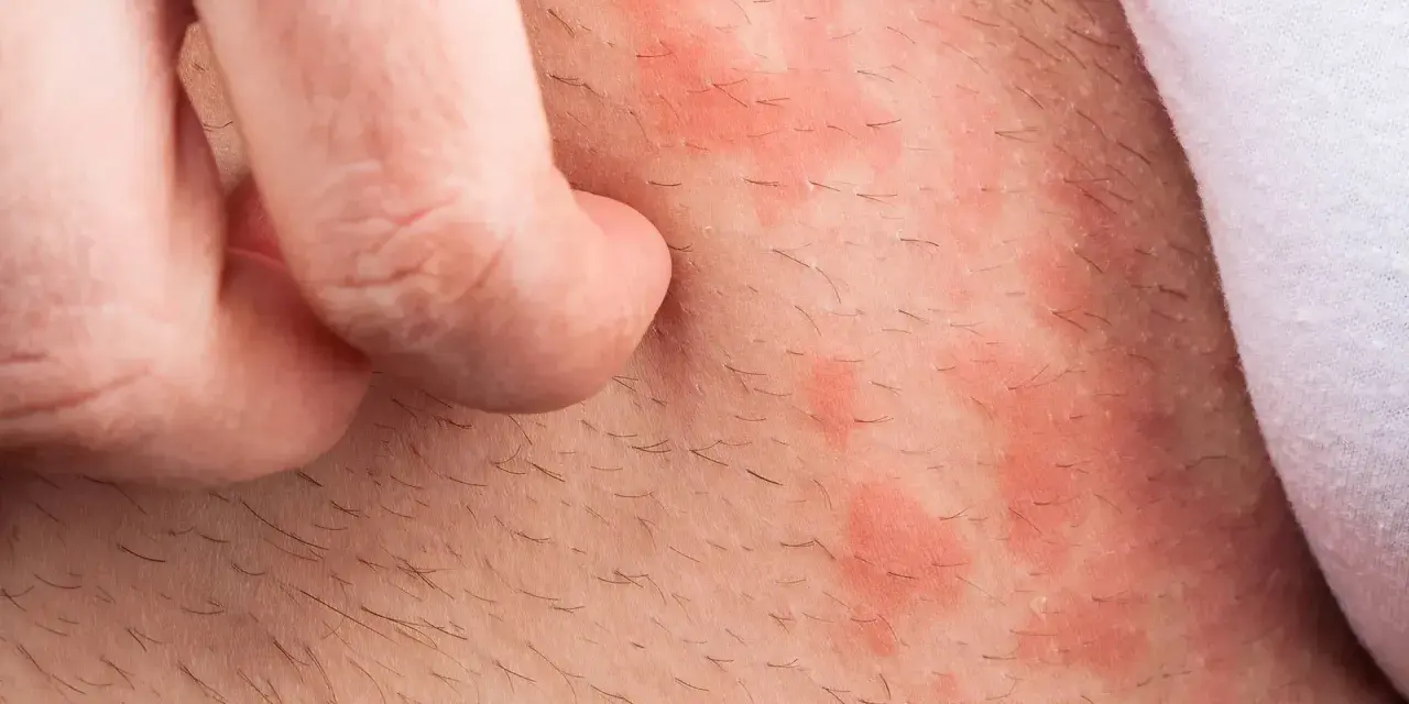 Haut mit roten Flecken und Haaren, die von einem Finger gekratzt werden. Backpulver gegen Juckreiz könnte Linderung verschaffen.