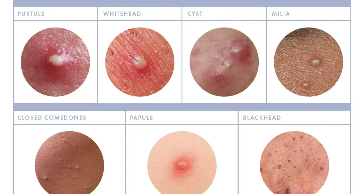 Close-up images show various types of acne, including pustules, whiteheads, cysts, milia, closed comedones, papules, and blackheads. Some show small white bumps on the face.