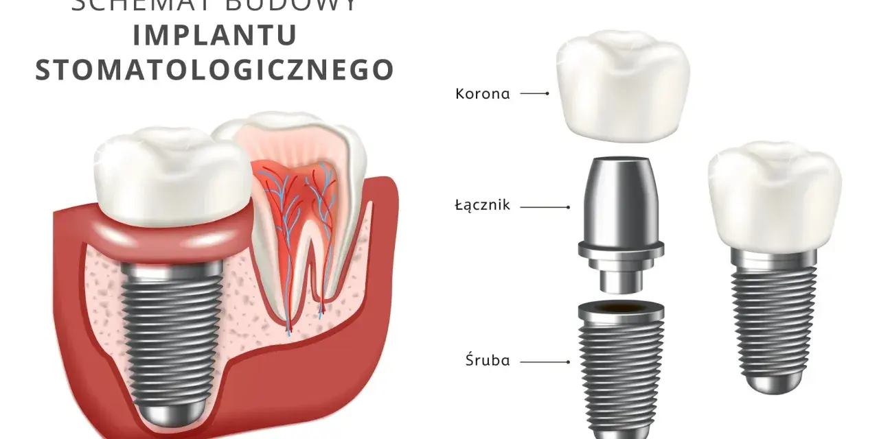 Schemat budowy implantu stomatologicznego: korona, łącznik i śruba.